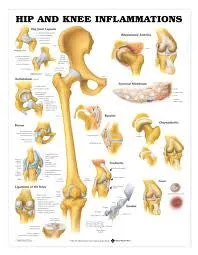 Hip and Knee Inflammations